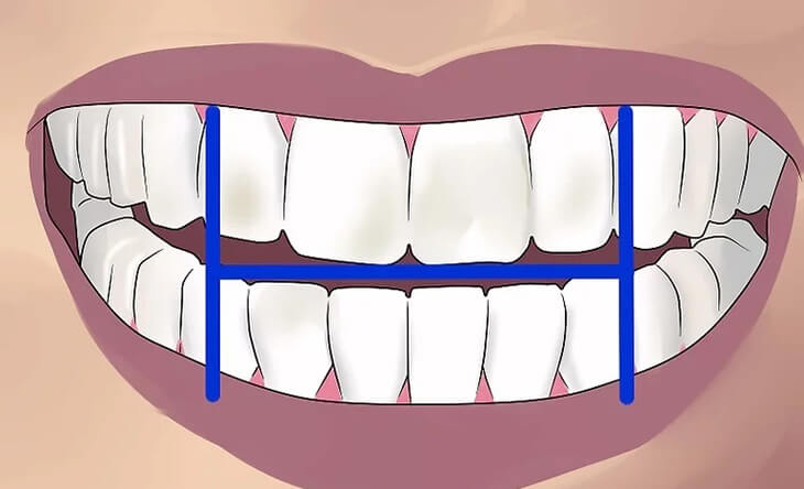 chia khoang miệng làm 4 khu vực khi đánh răng bằng bản chải điện