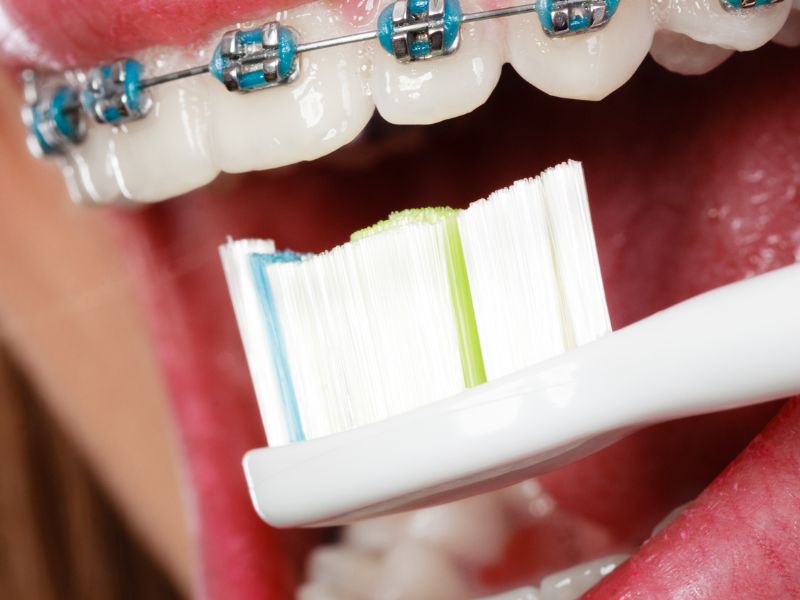 Hướng dẫn sử dụng bàn chải điện khi niềng răng: chú ý đến thời gian và tần suất chải răng