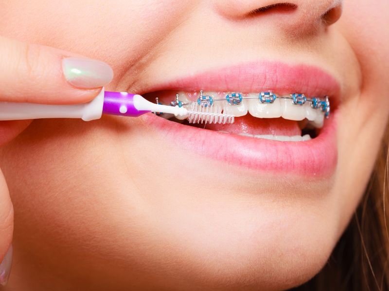 Hướng dẫn sử dụng bàn chải điện khi niềng răng: Kỹ thuật chải răng đúng cách