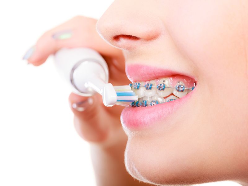 Lợi ích của việc sử dụng bàn chải điện khi niềng răng: Làm sạch rất tốt