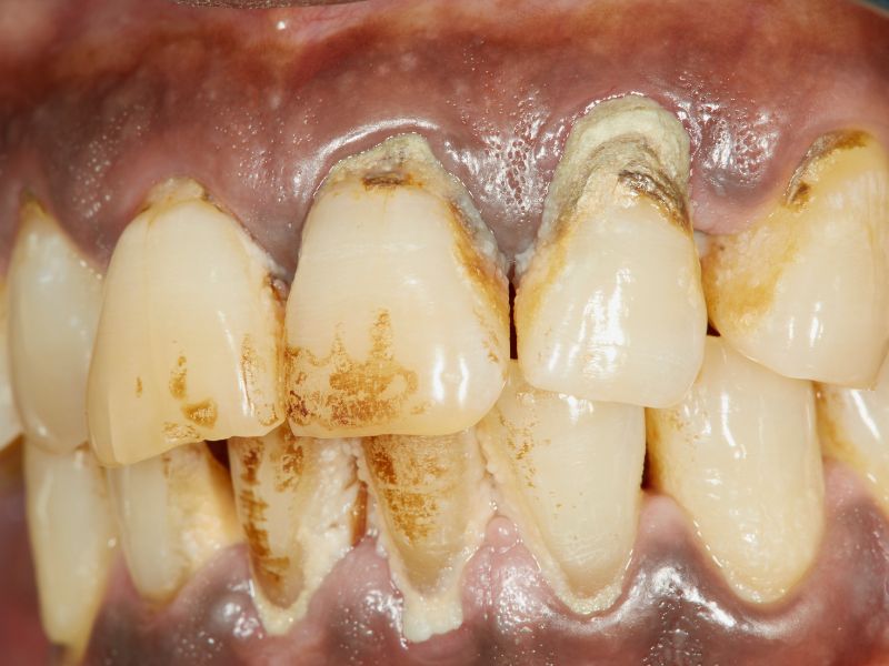 Đánh răng bằng bản chải điện có tốt không
